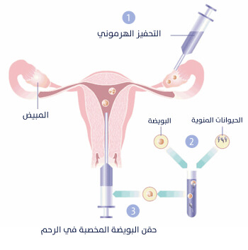 كيف تتم عملية اطفال الانابيب - شرح لعملية اطفال الانابيب الشهيره 255 2