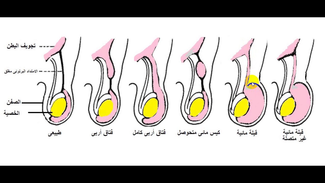 علاج القيلة المائية في الخصية بالاعشاب , مشاكل عند الرجال بسبب القيلة المائية