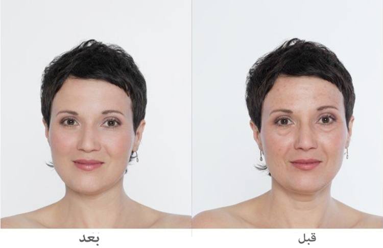 عمليات تجميل الوجه بالليزر - معلومات عن استخدام الليزر في عمليات التجميل 583 1