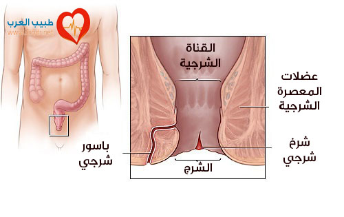 علاج الشرخ والبواسير , علاج طبي للشرخ و البواسير بسهوله